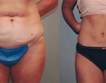 Tummy Tuck, New York | Before and After