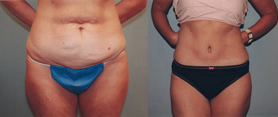Tummy Tuck, New York | Before and After