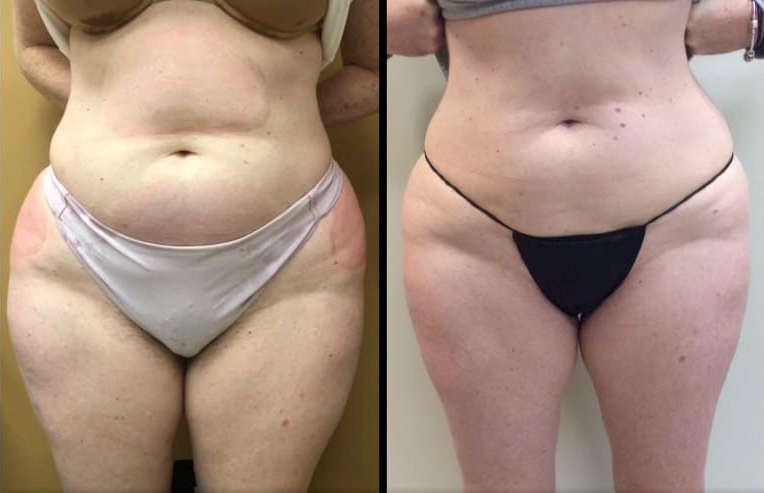 Before and After Liposuction photos