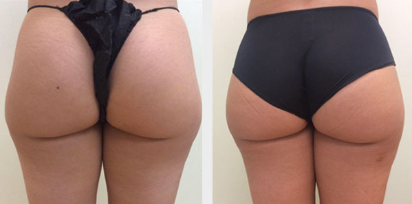 Lipo Before and After Photo