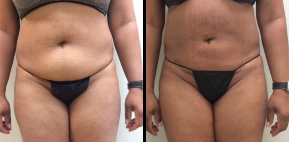 Lipo Before and After Photo
