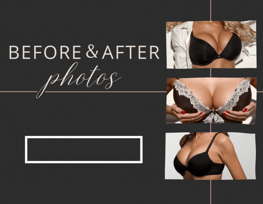 Dr. Fiorillo - Breast Augmentation Before and After Graphic (900x700)